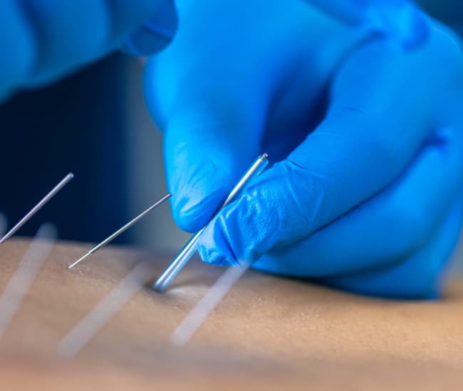 dry needling Zeeburg